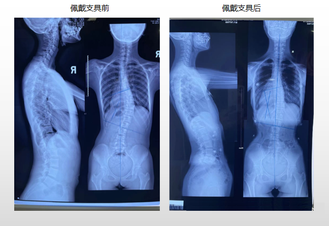 青少年脊柱側(cè)彎 昭通李景鏵醫(yī)院有“神器”-昭通李景鏵中醫(yī)骨傷醫(yī)院